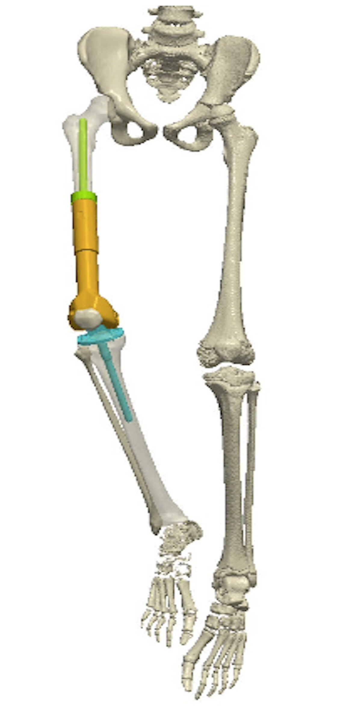 Cross-Cultural Adaptation and Validation of the Romanian Musculoskeletal Tumor Society Scoring System for Patients with Extremity Bone Sarcomas