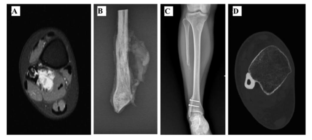 Distal Fibula Reconstruction in Primary Malignant Tumours