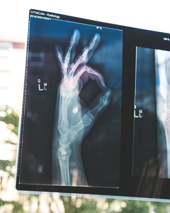 Radiografii ale unei mâini, pe negatoscop